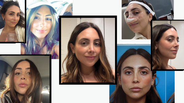 I Got a Revision Rhinoplasty to Fix My Nose Job&mdash;Before & After Photos